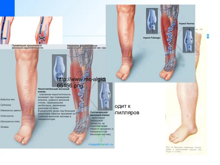 Застой венозной крови приводит к расширению вен, венул и капилляров http://www.mc-algida.ru/images/stati/4986165156.png