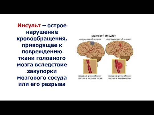 Инсульт – острое нарушение кровообращения, приводящее к повреждению ткани головного