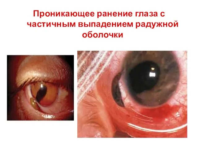 Проникающее ранение глаза с частичным выпадением радужной оболочки
