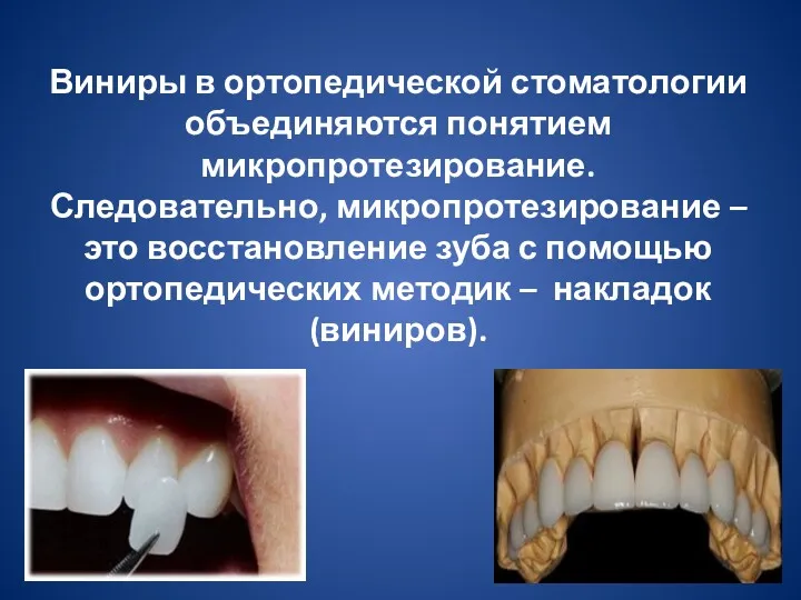 Виниры в ортопедической стоматологии объединяются понятием микропротезирование. Следовательно, микропротезирование –