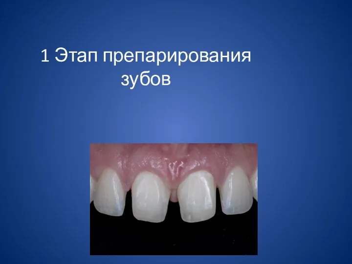 1 Этап препарирования зубов