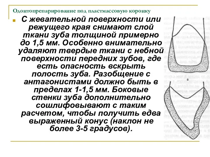 Одонтопрепарирование под пластмассовую коронку С жевательной поверхности или режущего края