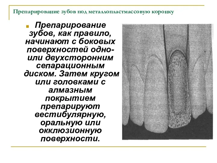 Препарирование зубов под металлопластмассовую коронку Препарирование зубов, как правило, начинают