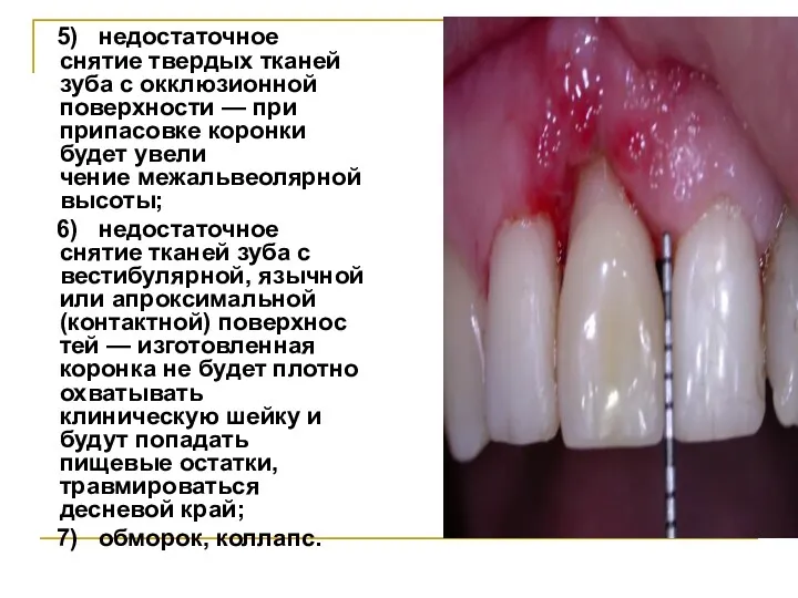 5) недостаточное снятие твердых тканей зуба с окклюзионной поверхности —