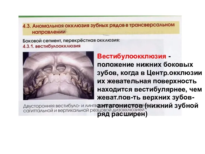 Вестибулоокклюзия - положение нижних боковых зубов, когда в Центр.окклюзии их жевательная поверхность находится