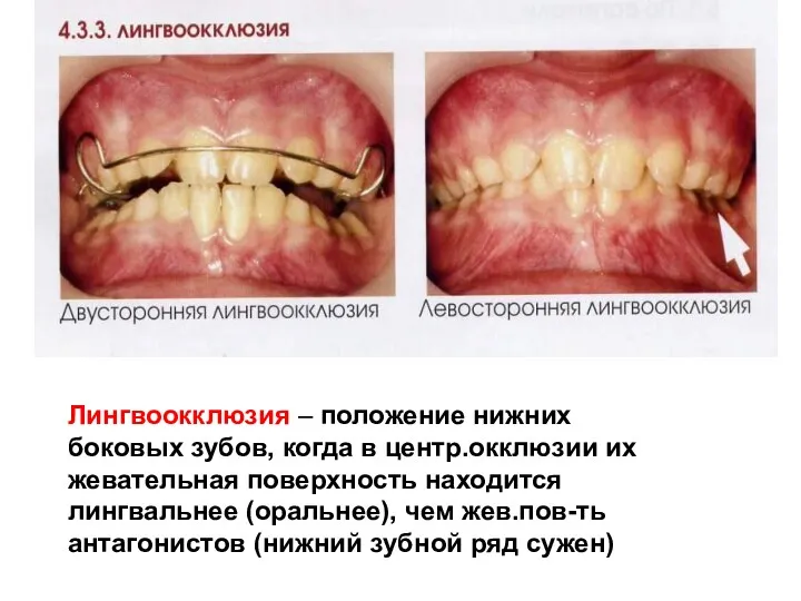 Лингвоокклюзия – положение нижних боковых зубов, когда в центр.окклюзии их жевательная поверхность находится