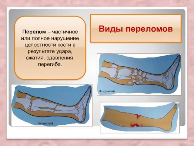 Виды переломов Перелом – частичное или полное нарушение целостности кости в результате удара, сжатия, сдавления, перегиба.