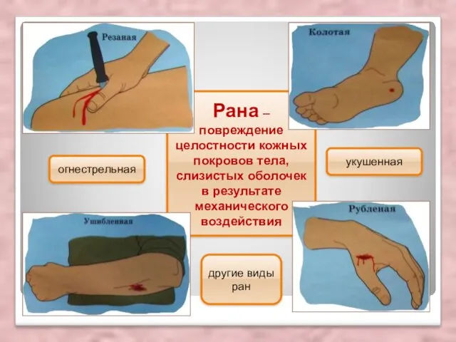 Рана – повреждение целостности кожных покровов тела, слизистых оболочек в