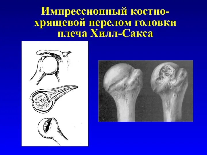 Импрессионный костно-хрящевой перелом головки плеча Хилл-Сакса