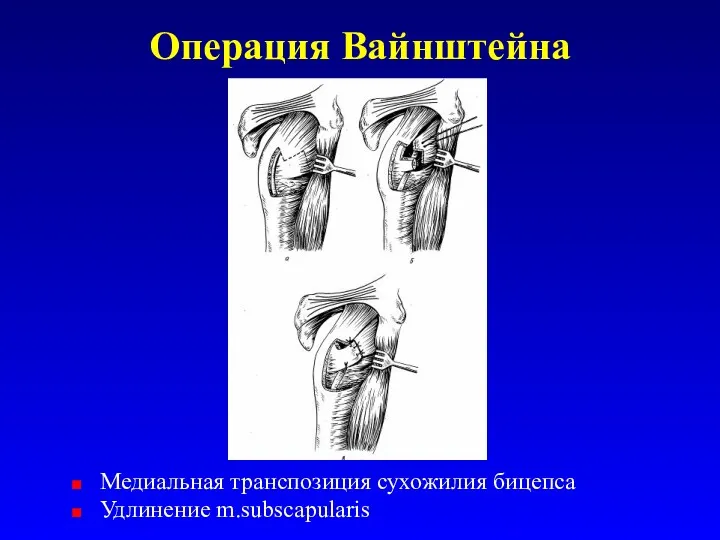 Операция Вайнштейна Медиальная транспозиция сухожилия бицепса Удлинение m.subscapularis