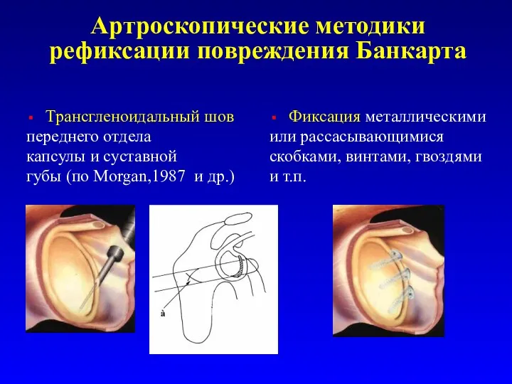 Артроскопические методики рефиксации повреждения Банкарта Tрансгленоидальный шов переднего отдела капсулы