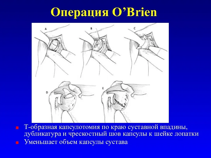 Операция O’Brien Т-образная капсулотомия по краю суставной впадины, дубликатура и