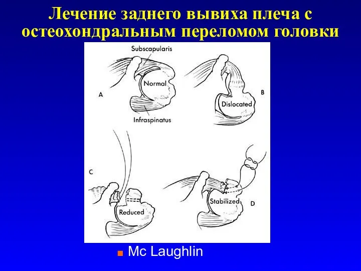 Лечение заднего вывиха плеча с остеохондральным переломом головки Mc Laughlin