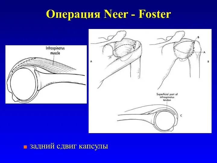 Операция Neer - Foster задний сдвиг капсулы