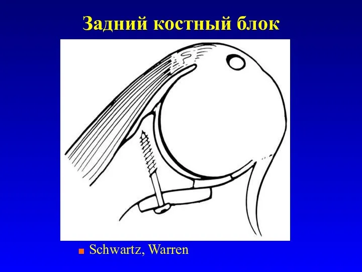 Задний костный блок Schwartz, Warren