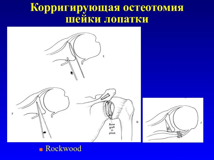 Корригирующая остеотомия шейки лопатки Rockwood