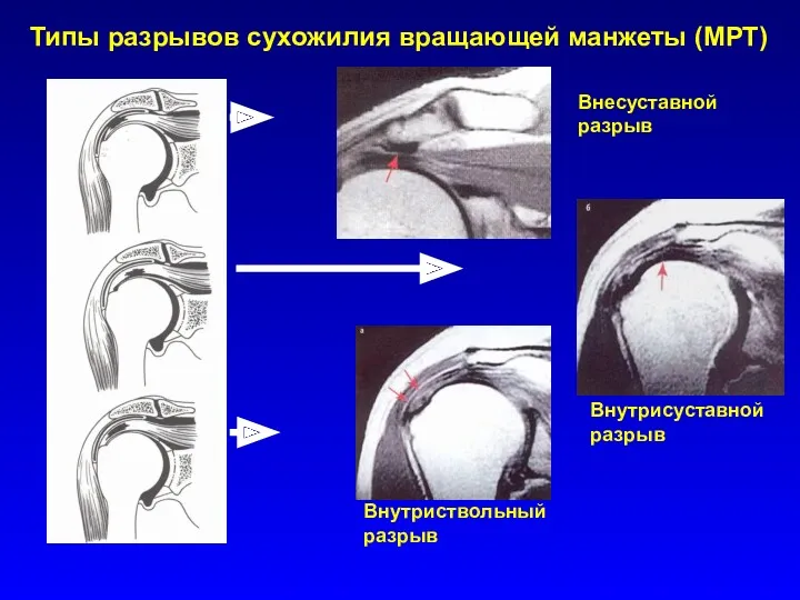 Внесуставной разрыв Внутриствольный разрыв Внутрисуставной разрыв Типы разрывов сухожилия вращающей манжеты (МРТ)