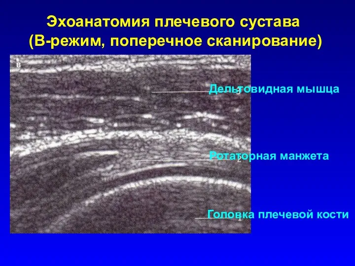 Эхоанатомия плечевого сустава (В-режим, поперечное сканирование) Дельтовидная мышца Ротаторная манжета Головка плечевой кости