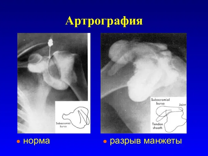 Артрография норма разрыв манжеты