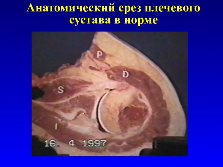 Анатомический срез плечевого сустава в норме