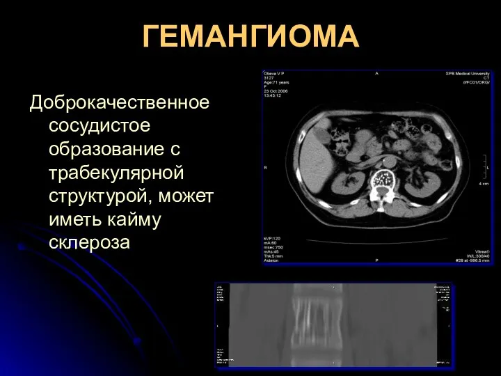 ГЕМАНГИОМА Доброкачественное сосудистое образование с трабекулярной структурой, может иметь кайму склероза