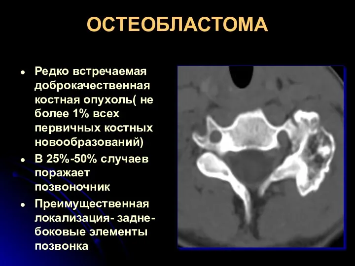 ОСТЕОБЛАСТОМА Редко встречаемая доброкачественная костная опухоль( не более 1% всех