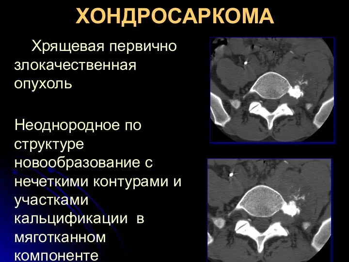 ХОНДРОСАРКОМА Хрящевая первично злокачественная опухоль Неоднородное по структуре новообразование с