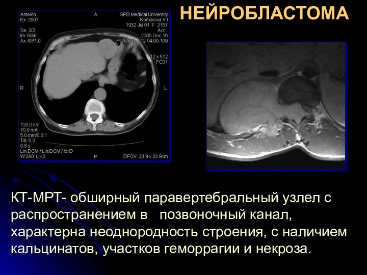 НЕЙРОБЛАСТОМА КТ-МРТ- обширный паравертебральный узлел с распространением в позвоночный канал,