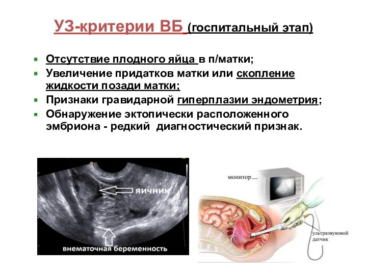 УЗ-критерии ВБ (госпитальный этап) Отсутствие плодного яйца в п/матки; Увеличение придатков матки или