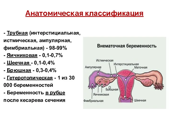 Анатомическая классификация - Трубная (интерстициальная, истмическая, ампулярная, фимбриальная) - 98-99% - Яичниковая -