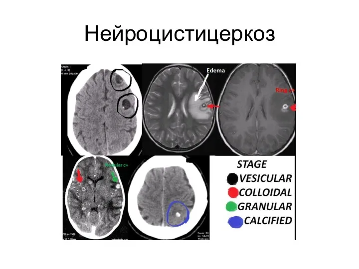 Нейроцистицеркоз