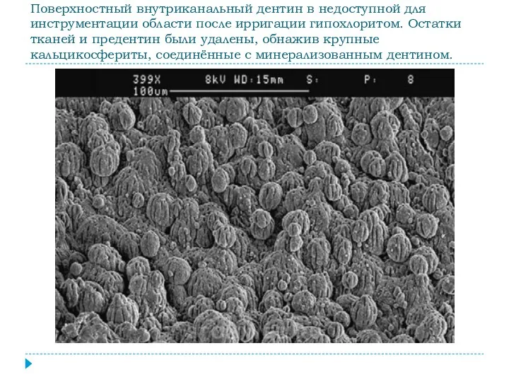 Поверхностный внутриканальный дентин в недоступной для инструментации области после ирригации