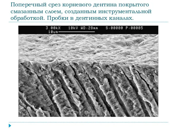 Поперечный срез корневого дентина покрытого смазанным слоем, созданным инструментальной обработкой. Пробки в дентинных каналах.