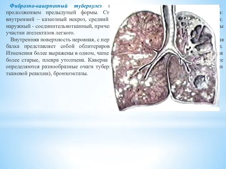 Фиброзно-кавернозный туберкулез имеет хроническое течение и является продолжением предыдущей формы.