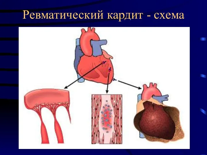 Ревматический кардит - схема