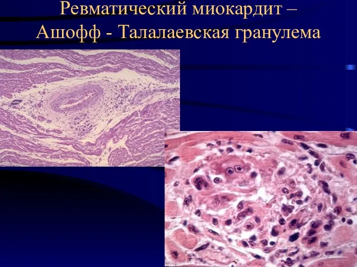 Ревматический миокардит – Ашофф - Талалаевская гранулема