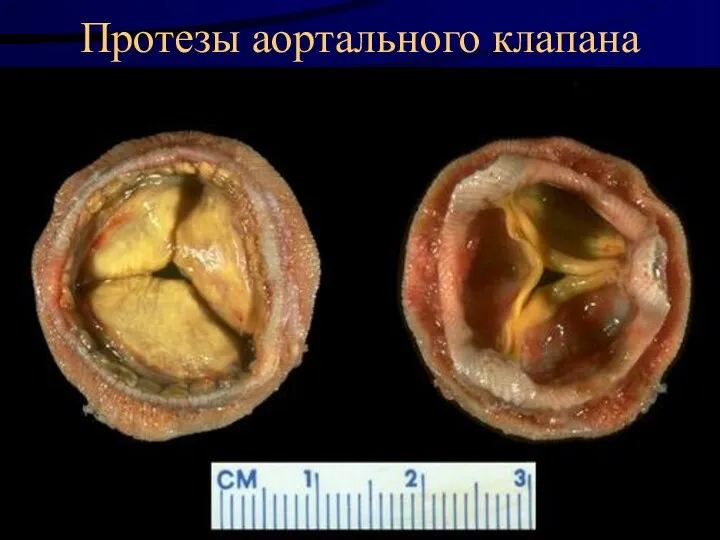 Протезы аортального клапана