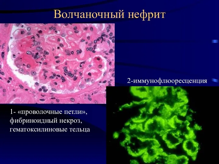 Волчаночный нефрит 1- «проволочные петли», фибриноидный некроз, гематоксилиновые тельца 2-иммунофлюоресценция