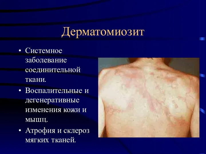 Дерматомиозит Системное заболевание соединительной ткани. Воспалительные и дегенеративные изменения кожи