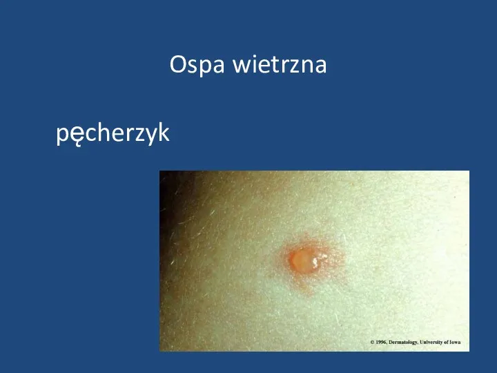 Ospa wietrzna pęcherzyk