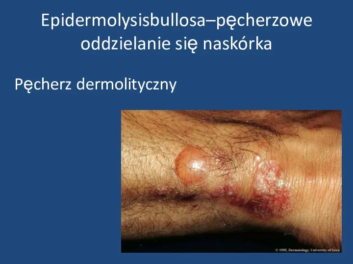 Epidermolysisbullosa–pęcherzowe oddzielanie się naskórka Pęcherz dermolityczny