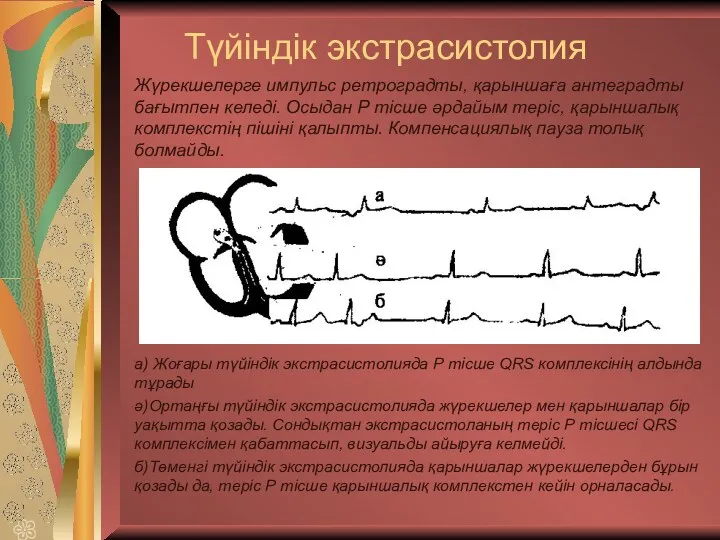 Жүрекшелерге импульс ретроградты, қарыншаға антеградты бағытпен келеді. Осыдан Р тісше