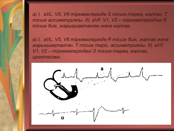 а) І, aVL, V5, V6 тіркемелерінде S тісше терең, жалпақ.