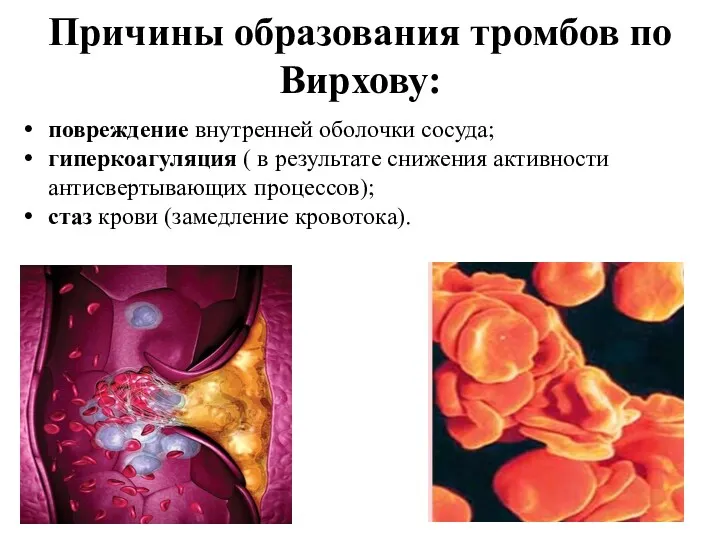 Причины образования тромбов по Вирхову: повреждение внутренней оболочки сосуда; гиперкоагуляция