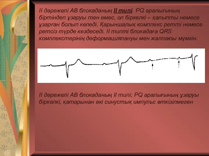 ІІ дәрежелі АВ блокаданың ІІ типі. PQ аралығының біртіндеп ұзаруы