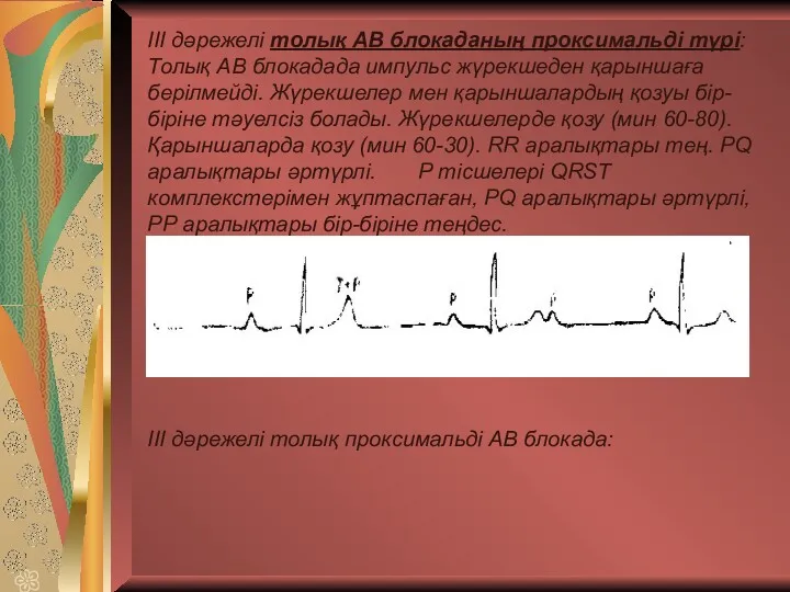 ІІІ дәрежелі толық АВ блокаданың проксимальді түрі: Толық АВ блокадада