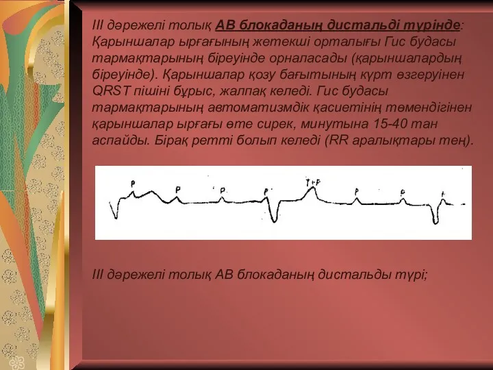 ІІІ дәрежелі толық АВ блокаданың дистальді түрінде: Қарыншалар ырғағының жетекші