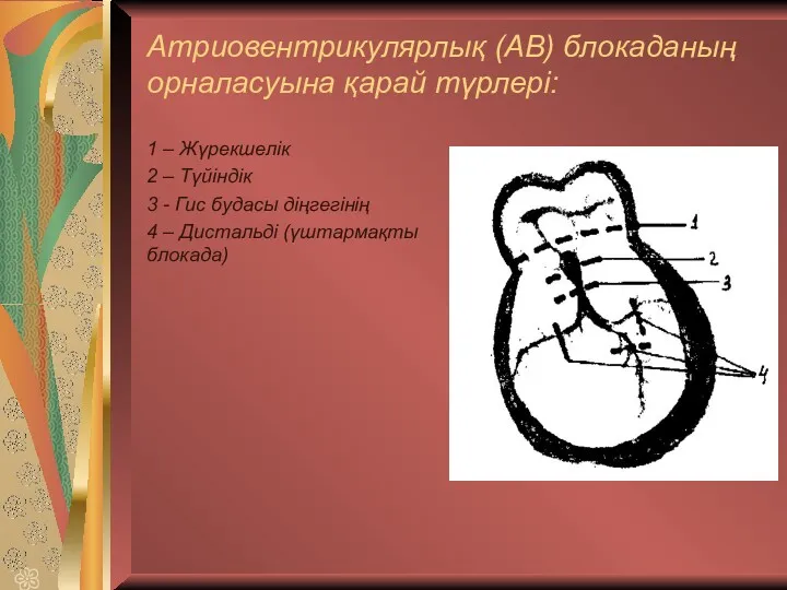 Атриовентрикулярлық (АВ) блокаданың орналасуына қарай түрлері: 1 – Жүрекшелік 2