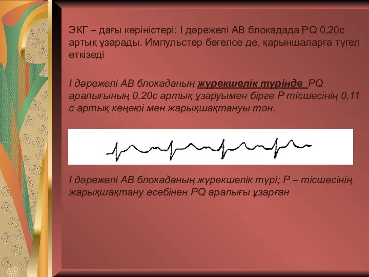 ЭКГ – дағы көріністері: І дәрежелі АВ блокадада PQ 0,20с