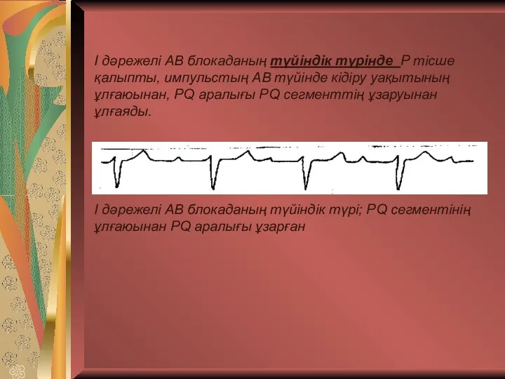 І дәрежелі АВ блокаданың түйіндік түрінде P тісше қалыпты, импульстың